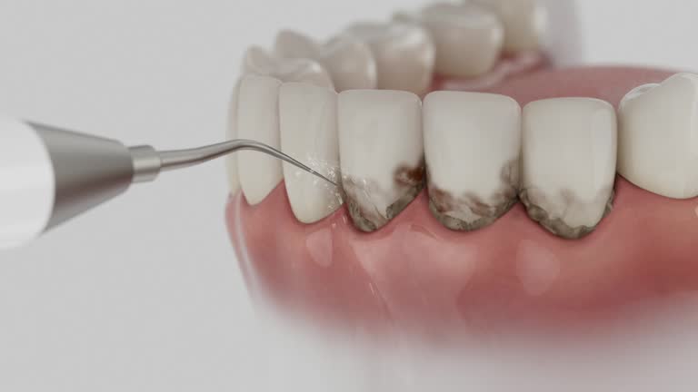 Trusted Wisdom Tooth Removal service in Morton, MS - Dentist Open Now